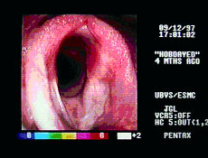 Endoscopic view of a larynx following “Hobday” surgery